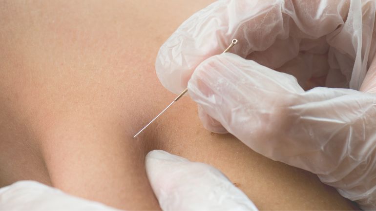 Dry Needling effektive Therapie für Schmerzen und Verletzungen